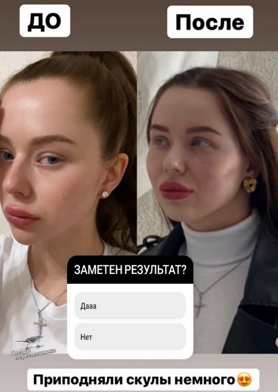 У Татьяны Репиной новые скулы