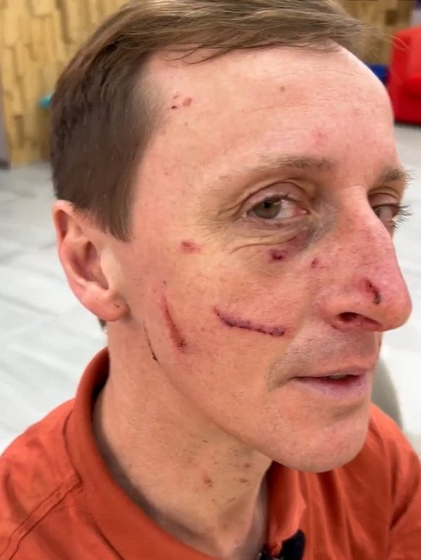 Вероника Гракович подпортила лицо своему мужу Альберту Вероника Гракович подпортила лицо своему мужу Альберту